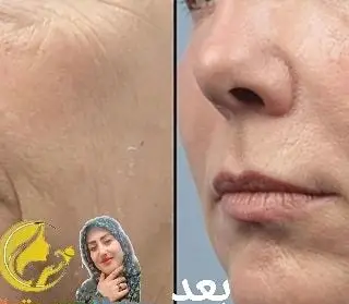 مقایسه قبل و بعد از درمان چین و چروک دور دهان و جوانسازی پوست صورت در کلینیک زیبایی سارا خاتون با روشهای نوین