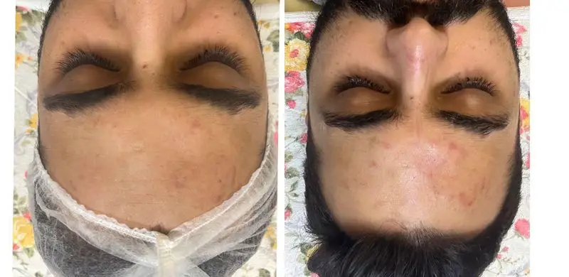 مقایسه قبل و بعد از خدمات پاکسازی و فیشیال تخصصی پوست پیشانی آقایان جهت رفع لک و جوش در مرکز پوست و زیبایی شبنم