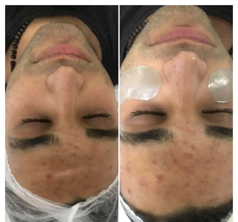 مراحل فیشیال تخصصی و پاکسازی پوست صورت آقایان همراه با پد زیر چشم در مرکز زیبایی شبنم برای رفع لک و جوش‌های پوستی