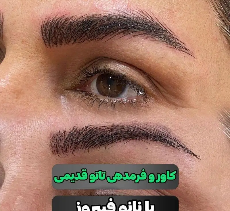 نمونه کار کاور و فرم دهی تاتو قدیمی ابرو با تکنیک نانو فیبروز و میکروبلیدینگ جهت اصلاح فرم و قرینه‌سازی طبیعی ابروها