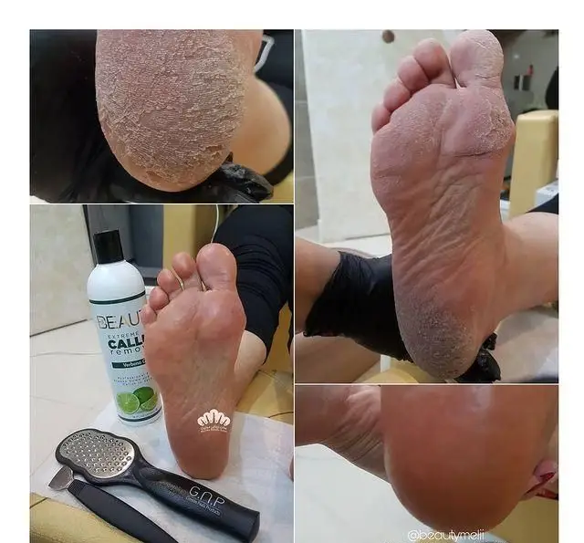 مراحل پدیکور و کفسابی پا با استفاده از سوهان و لوسیون مخصوص برای رفع ترک و خشکی شدید پاشنه پا در سالن زیبایی.