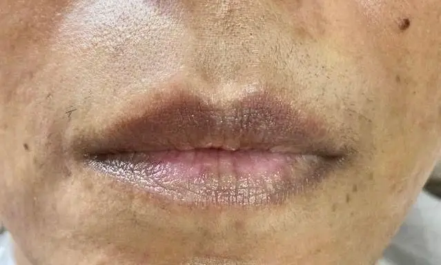 لب‌های تیره و موهای زائد صورت قبل از خدمات تخصصی در سالن زیبایی و اپیلاسیون کیانا برای رژلب دائم و رفع موهای زائد. زیبایی و اعتماد به نفس بیشتر با ما.