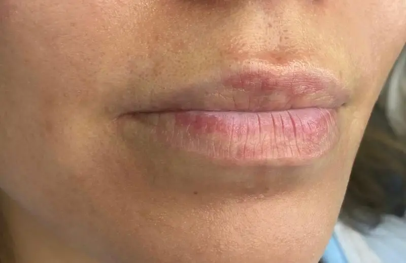 لب‌های مشتری با علائم خشکی، ترک و قرمزی نیازمند مراقبت تخصصی پوست لب در سالن زیبایی کیانا برای جوانسازی.