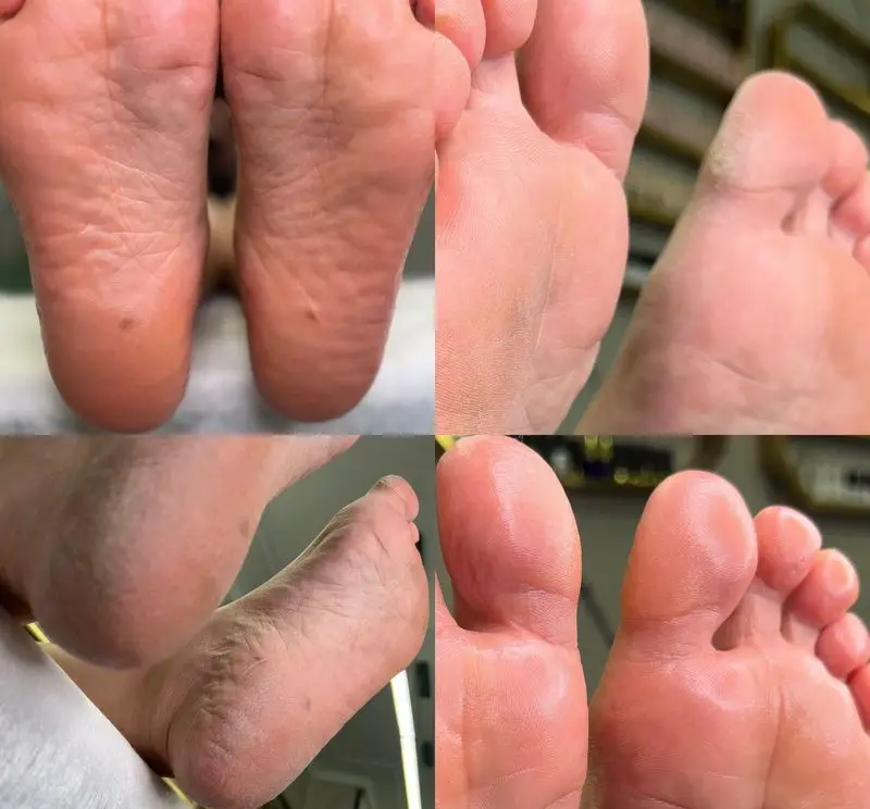 تصاویر قبل و بعد کفسابی و پدیکور تخصصی پا جهت درمان خشکی، ترک پاشنه و پوسته‌پوسته شدن برای داشتن پوست پای نرم و لطیف