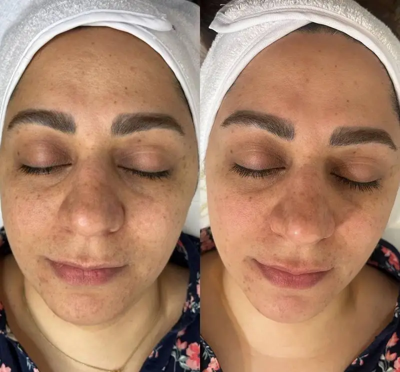 عکس قبل و بعد از انجام فیشیال و پاکسازی تخصصی پوست صورت به همراه میکروبلیدینگ ابرو برای جوانسازی و رفع لک