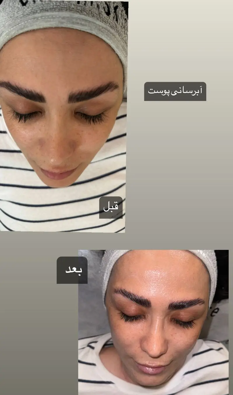 نتیجه میکروبلیدینگ و جوانسازی پوست در سالن زیبایی إلانیم، لبخند رضایت مشتری پس از خدمات احیای پوست و ابرو.