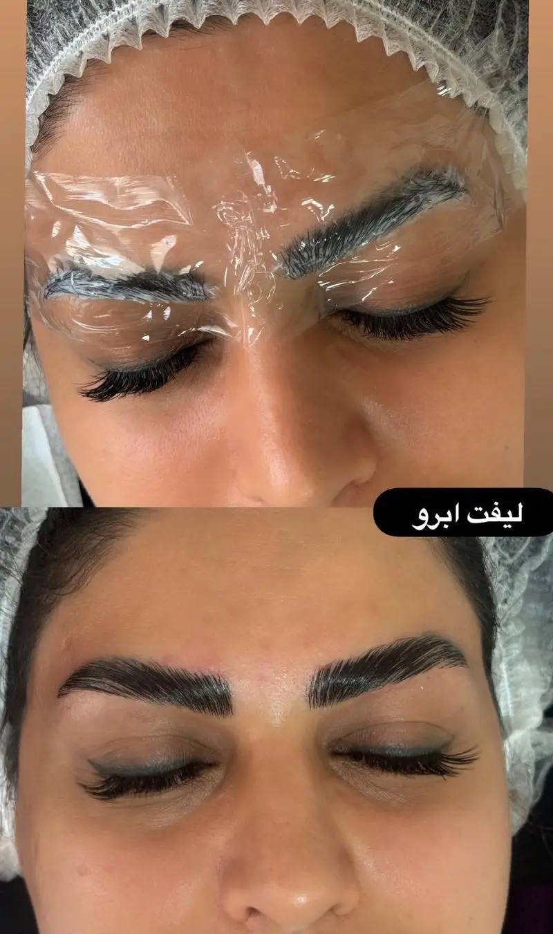 مراحل انجام لیفت ابرو تخصصی به همراه عکس قبل و بعد از حالتدهی و تقویت ابروها با مواد درجه یک در کلینیک زیبایی
