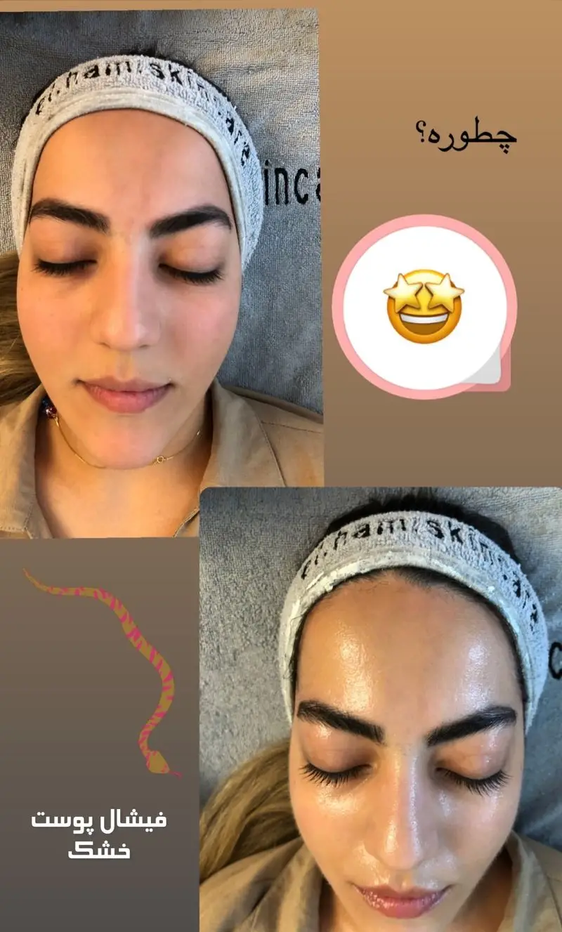 مقایسه قبل و بعد از فیشیال پوست خشک و آبرسانی عمیق صورت که باعث افزایش درخشندگی، شادابی و رفع کامل خشکی پوست شده است