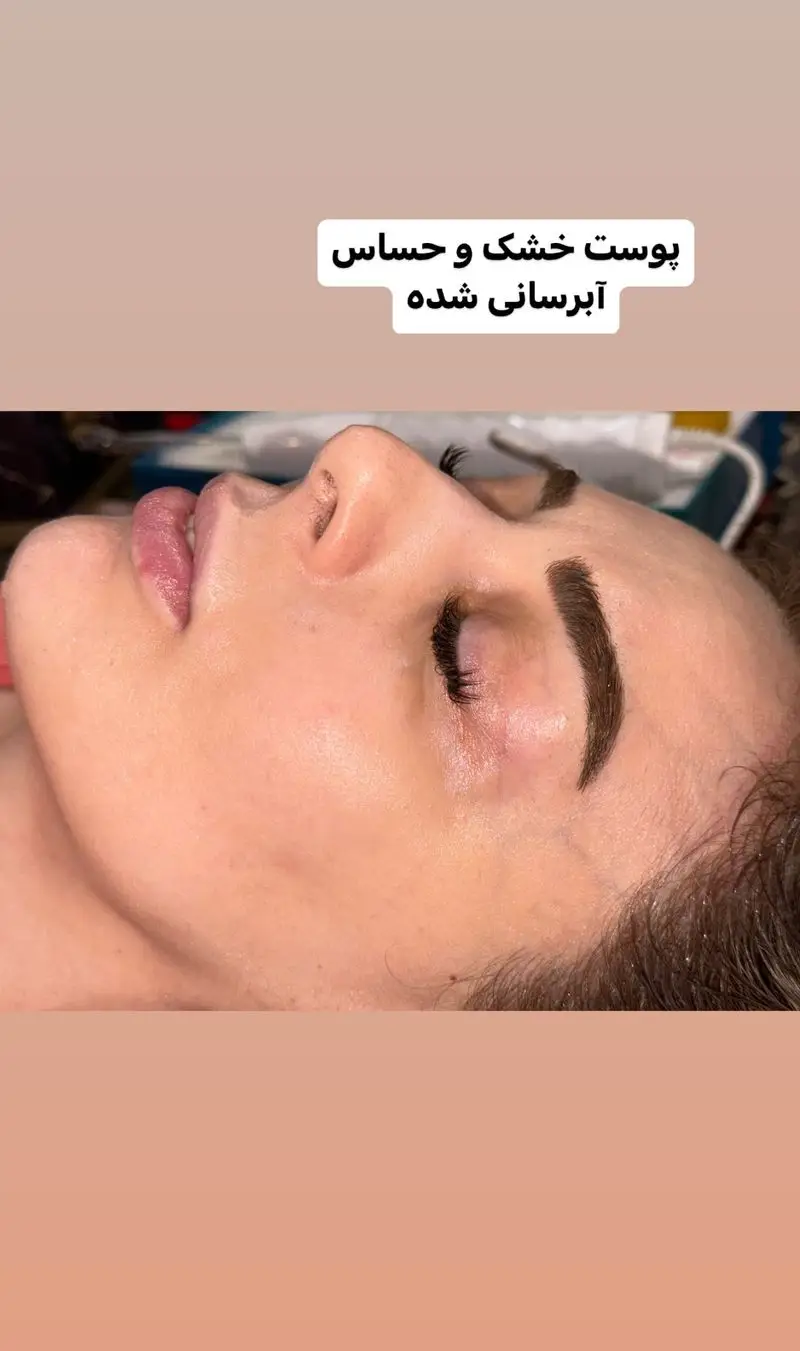 خدمات آبرسانی عمیق پوست خشک و حساس در سالن زیبایی إلانیم. بهترین روش مراقبت و فیشیال صورت برای داشتن پوستی شاداب و سالم.
