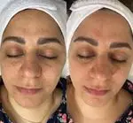 نمونه قبل و بعد فیشیال تخصصی در سالن زیبایی هیلان. روشن‌کنندگی و بهبود بافت پوست صورت، کاهش لک‌ها و افزایش طراوت و جوانی.
