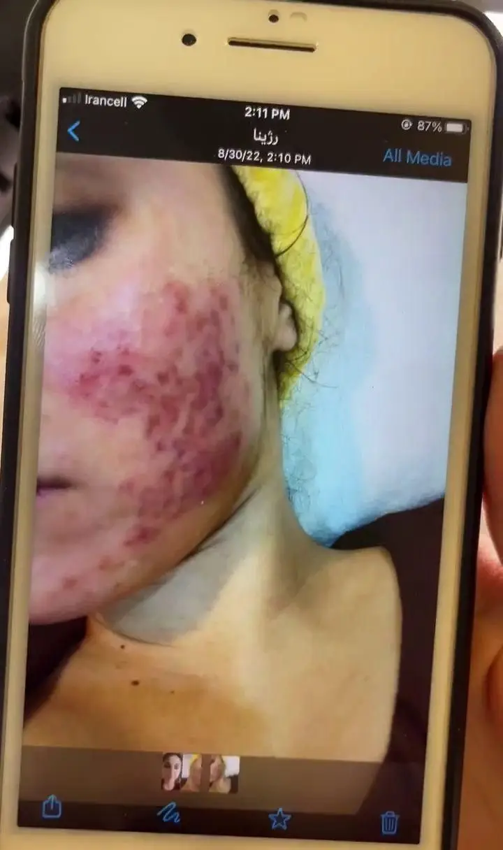 عکس روی صفحه موبایل از جوشها و التهابات شدید پوستی روی صورت مشتری قبل از انجام پاکسازی در سالن زیبایی مرجان لطفی
